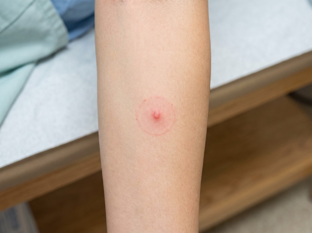 Close-up of a fresh longhorn beetle bite mark showing a small red pinch mark and early blister on a finger